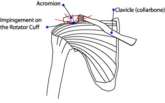 импинджмент плечелопаточный периартроз артроскопия плечевой сустав